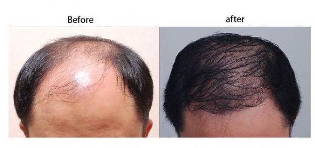 業界最新的植髮技術CIT，提高毛囊存活率